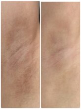 テセラ(Tethere)/ローマピンク