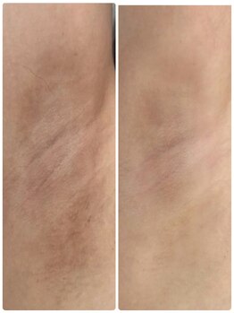 テセラ(Tethere)/ローマピンク