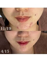 アルムダアクア 天王寺店(Aleumda AQUA)/ハーブピーリング/大阪/天王寺