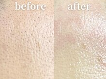 ラティエル(Latiele)/眉間、額も！！無添加毛穴ケア