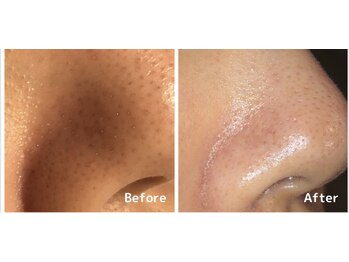 ウイ 津幡店(Ui)/毛穴洗浄