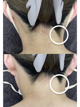 カルディエ(Cardie)/うなじ脱毛　ビフォーアフター