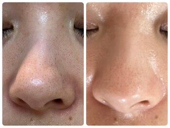 ベルドア(Bell Door)/ビタミンA導入×角質ケア