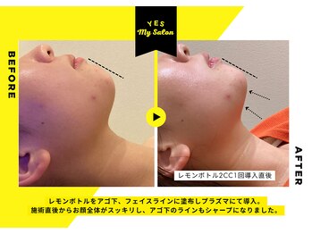 イエス マイサロン(yes My Salon)/レモンボトル施術例