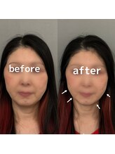 オアソラ(oasora)/美容鍼施術１回目