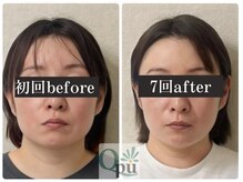 キュープ 奈良天理店(Qpu)の雰囲気（エラ/ボト卒業するお客様続出中！小顔矯正/小顔/エラ/奈良/天理）