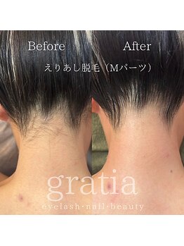 グラーティア(gratia)/えりあし脱毛【パーツ脱毛】