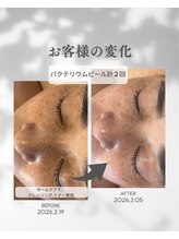 プレジール(Plaisir)/お手入れ2回・ホームケア使用