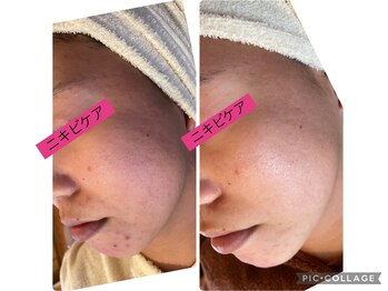 ポアレ(POARE)/1回施術　スピキュールハーブ