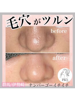 ナンバー511(No.511)/毛穴エクストラクションプロ
