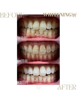 ネス 沖縄店(Nes.)/ホワイトニング