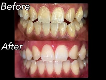 ホワイトニングビューティー 吉祥寺店/症例写真_3回来店されたお客様