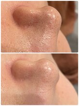 サロンメロウ 大牟田店(salon mellow)/毛穴洗浄で毛穴悩み、丸ごと改善