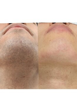 ダリアビューティー(Dahlia Beauty)/Before After画像