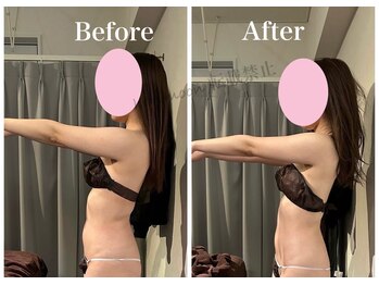 ハリムーン 仙台(harimoon)/お腹ビフォーアフター