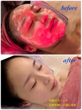 ティアラ(TIARA)/炭酸ガスパック