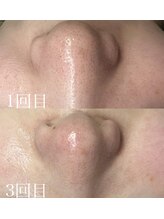 アディ(Adiy)/毛穴ケアコース