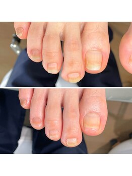 美爪ケア(足爪ケア)