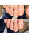 美爪ケア(足爪ケア)