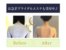 ルーナ(LUNA)/お急ぎブライダルエステにも♪