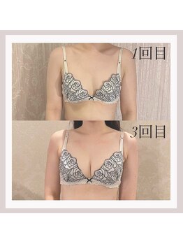 アリサナ(Arisana)/症例写真　バスト　葛西