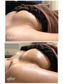 美人バスト 町田店/バストアップ◇症例◇