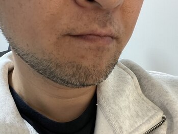 リノ(Lino)/メンズ脱毛 髭