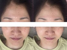 サクラ 本厚木駅前店(SAKURA)/ハーブピーリング