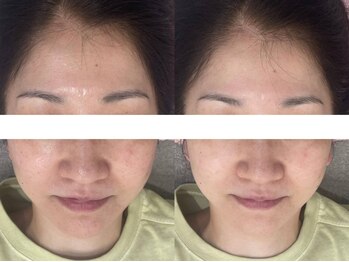 サクラ 本厚木駅前店(SAKURA)/ハーブピーリング