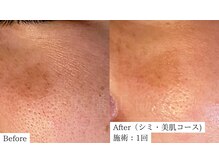 【医師監修】シミ/毛穴/たるみケア専門店 Frohの雰囲気(次世代シミケア◇あらゆるシミにアプローチ!そば〇す/〇斑も◎)