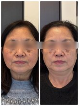 クレル(Clair)/70代　before→after