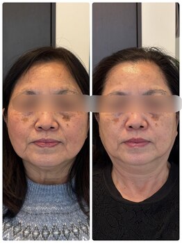 クレル(Clair)/70代　before→after