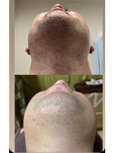 ラリス(LARISS)/men's髭脱毛