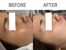 ライム バイ アネラ 高崎(LIME By Anela)/ハーブピーリング/肌質改善