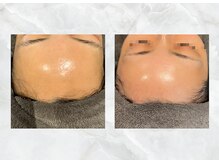 ロイズ(LOYS)/ララピール