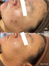 フルール(Fleur)/◆肌荒れ/毛穴/シミケア◆