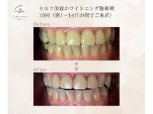 サレンダー(SURRENDER)/セルフホワイトニング施術例