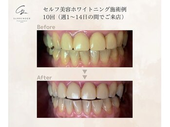サレンダー(SURRENDER)/セルフホワイトニング施術例