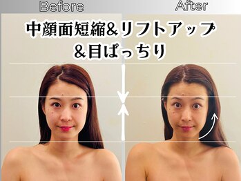 リストアハート(Restore Heart)/リフトアップ&目元がスッキリ