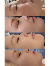 ソートトータルビューティーリッシュ(THOUGHT TOTAL BEAUTY Rish)/シミケア4ヶ月での変化