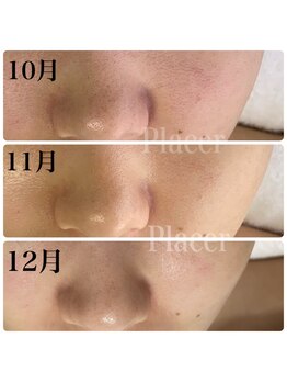 プラセル(Placer)/必要なものを使うだけ