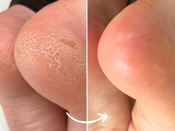 まつ毛エクステアンドネイル フィーカ 新松戸(FIKA)の写真/【足裏角質ケア単品予約OK】カチカチのかかとが１時間でふっくらツルツルに！タコ・魚の目も丁寧に除去★