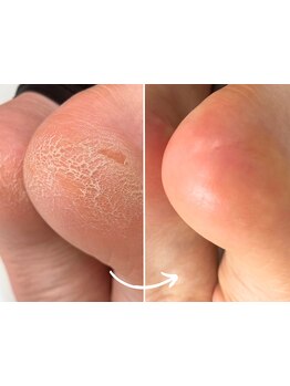 角質ケアができるサロン