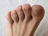 【初回限定】カウンセリング￥2200込み！巻き爪補正1か所☆美しい補正技術
