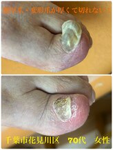 巻き爪じゅん 千葉駅前店/爪が厚くて自分では切れない！！