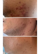 ウィズハーヴェ(w/haave)/メンズ　ハーブピーリング