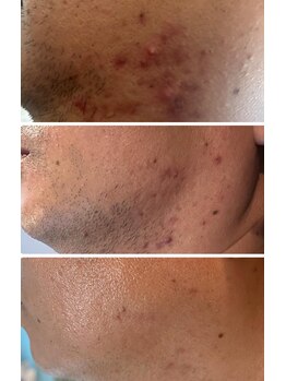 ウィズハーヴェ(w/haave)/メンズ ハーブピーリング