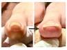 【無料】巻き爪カウンセリング　通常￥1,100→