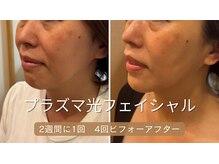 リラクゼーションルーム ココ(CoCo)の雰囲気（プラズマ光フェイシャル　ビフォーアフター）