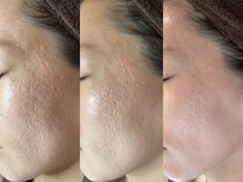 リードスラッシュ(LEAD/)/プロセルセラピーズお顔